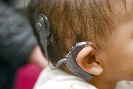 CochlearImplant2013-11-15.jpg